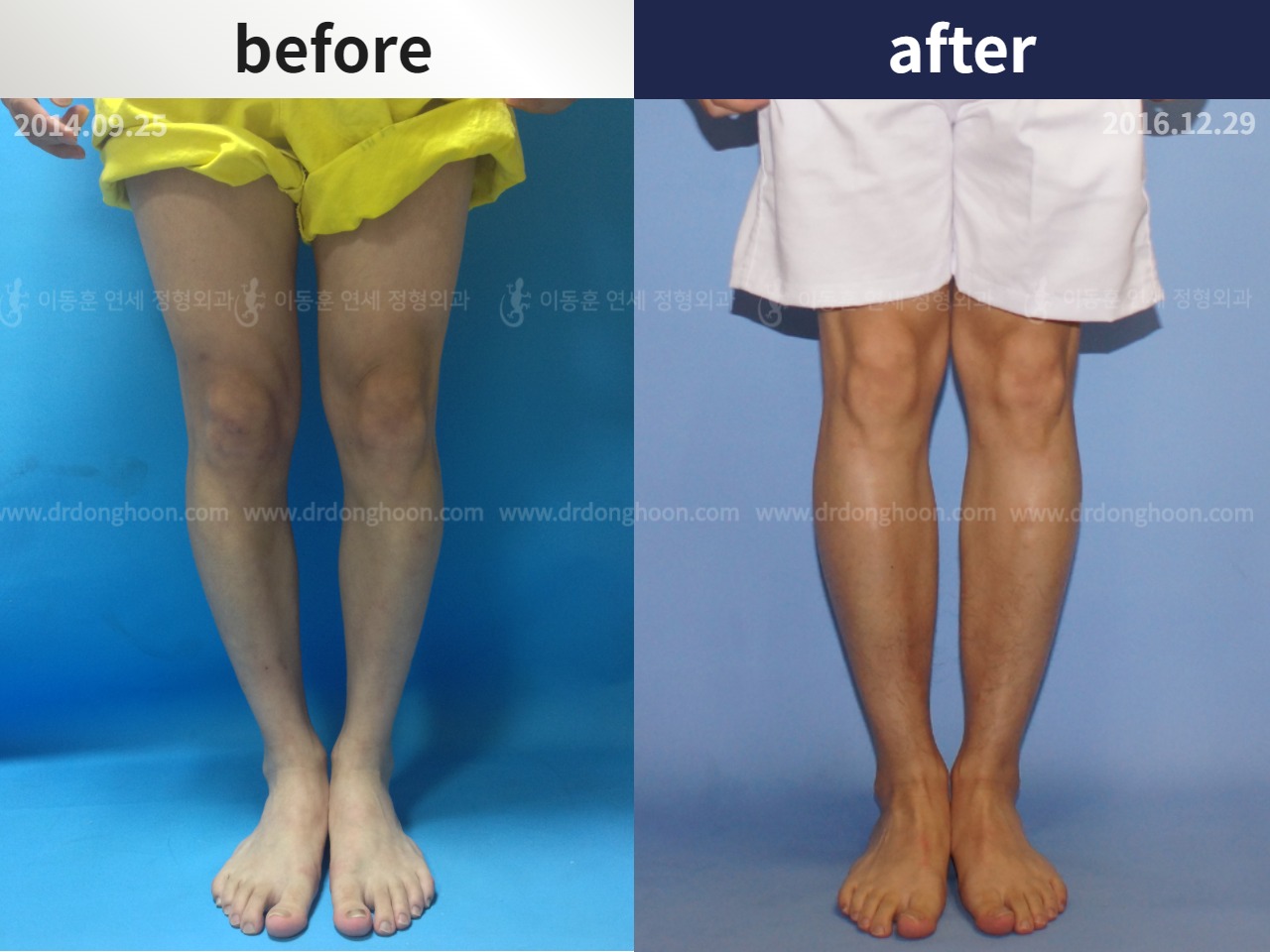 Before and after cll precice, case 4323235, image 1, Dr. Donghoon institute (DALRI)