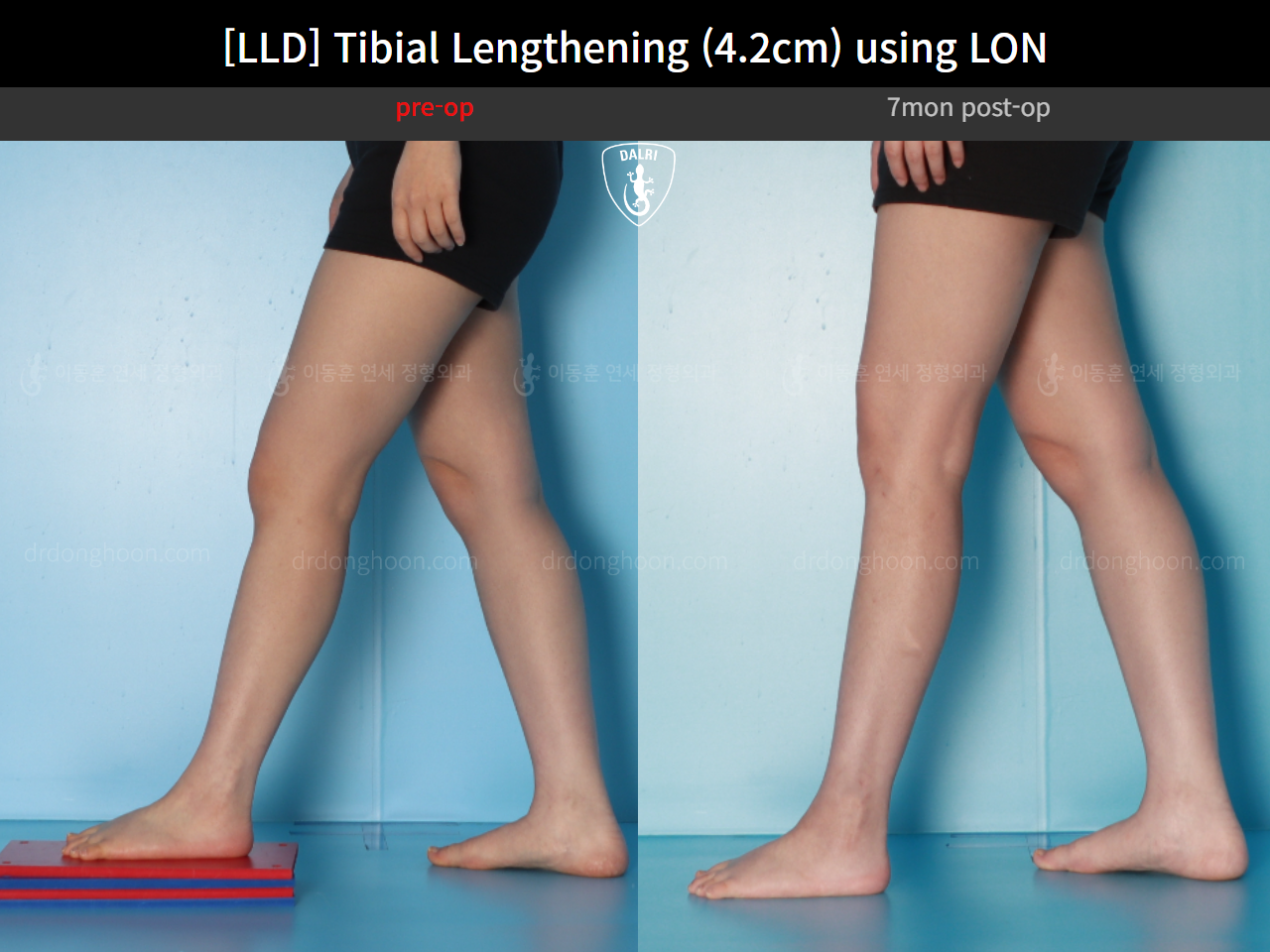 Before and after adult lld, case 16933852, image 8, Dr. Donghoon institute (DALRI)