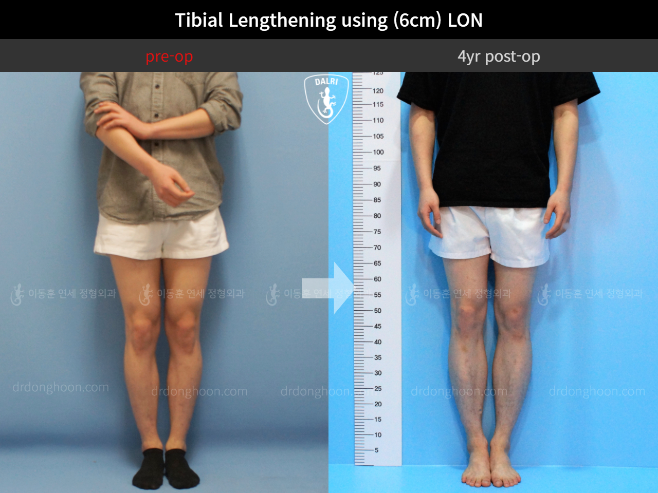 Before and after cll lon, case 4323452, image 3, Dr. Donghoon institute (DALRI)