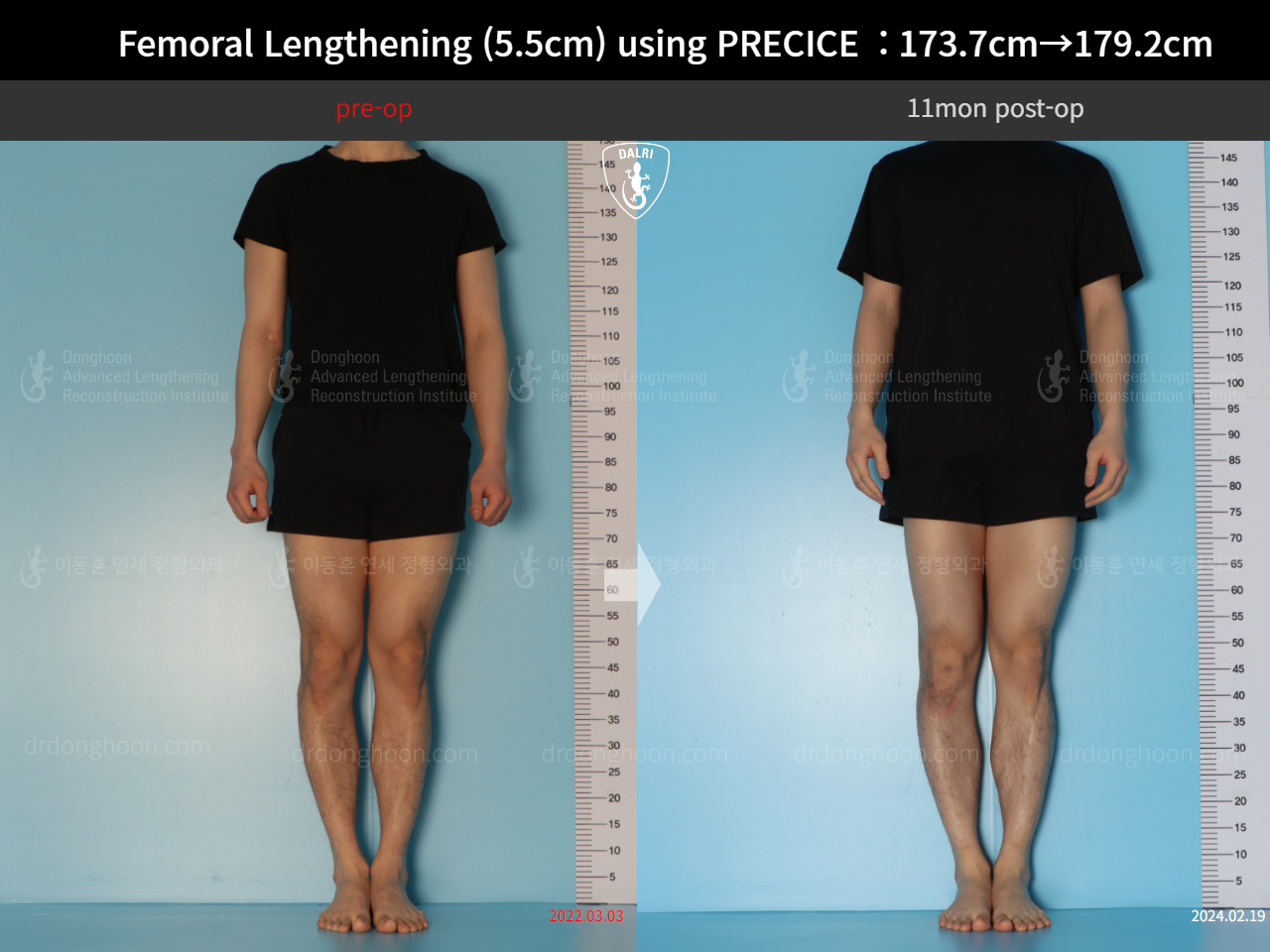 Before and after cll precice, case 18140453, image 1, Dr. Donghoon institute (DALRI)