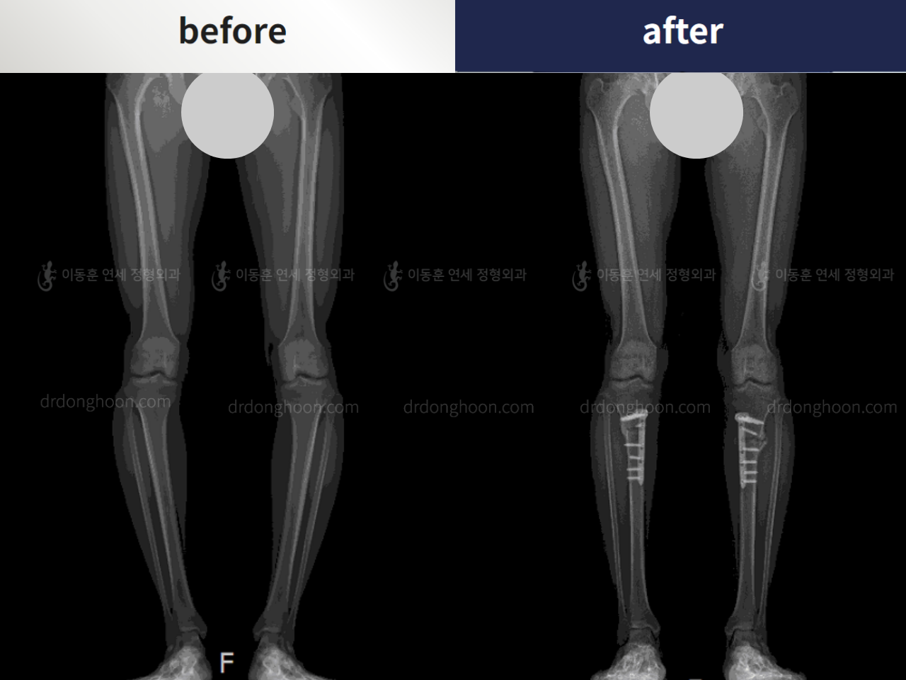Before and after complex deformity, case 4297349, image 3, Dr. Donghoon institute (DALRI)