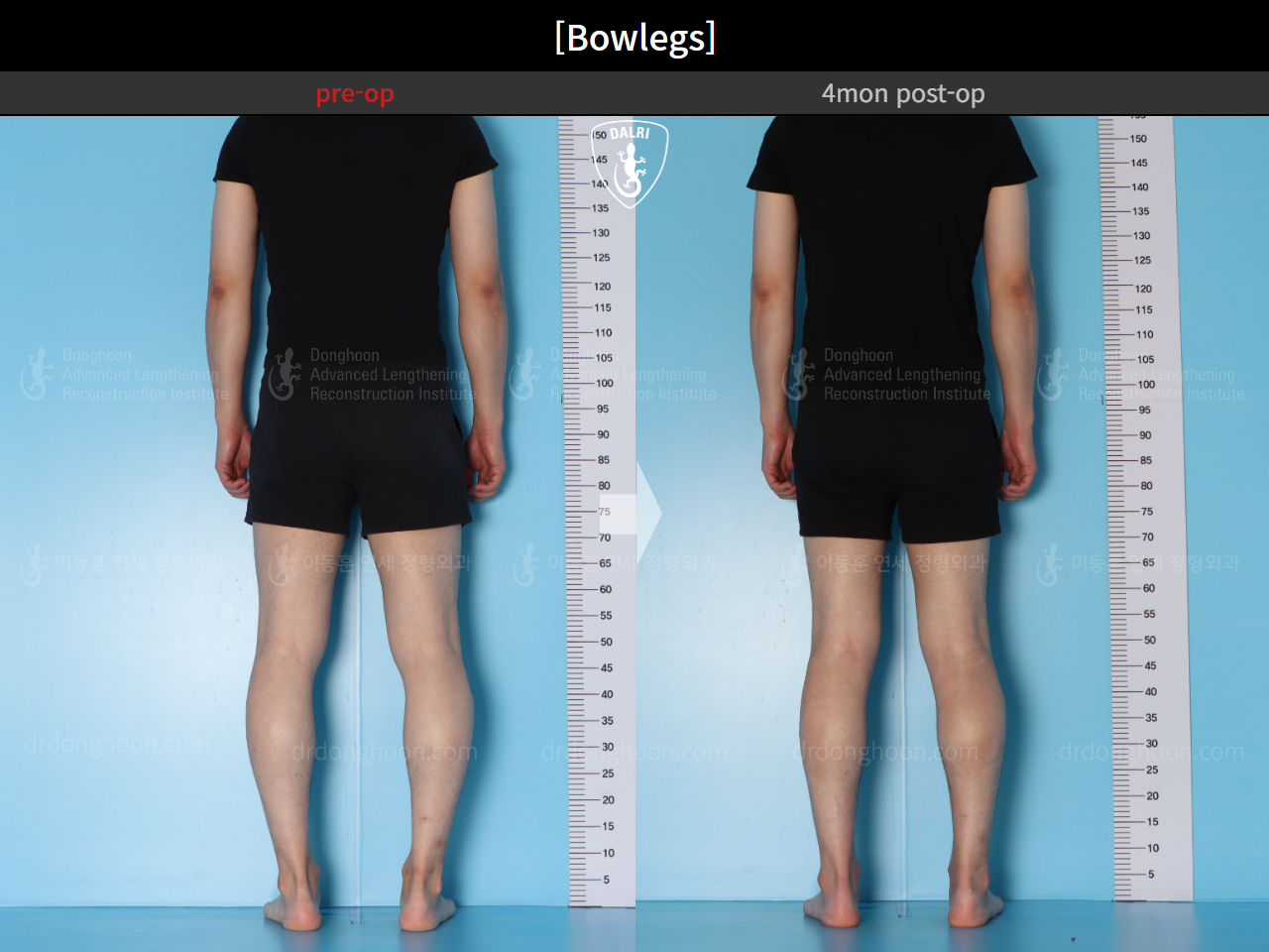 Before and after adult bowlegs, case 15650289, image 5, Dr. Donghoon institute (DALRI)