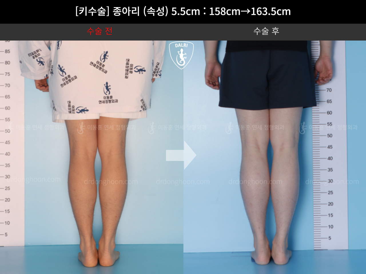 Before and after cll lon, case 4577764, image 6, Dr. Donghoon institute (DALRI)