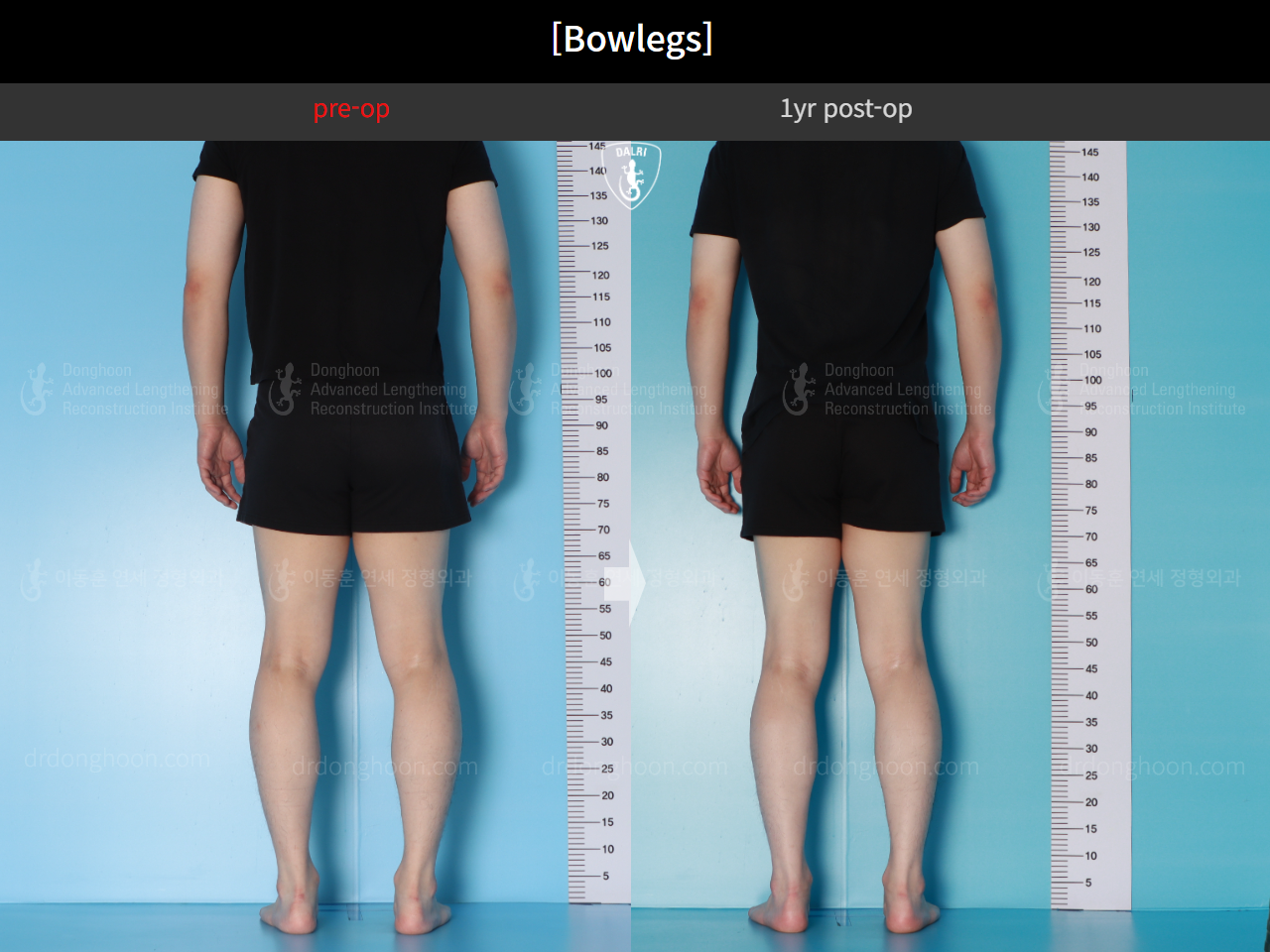 Before and after adult bowlegs, case 16724494, image 4, Dr. Donghoon institute (DALRI)