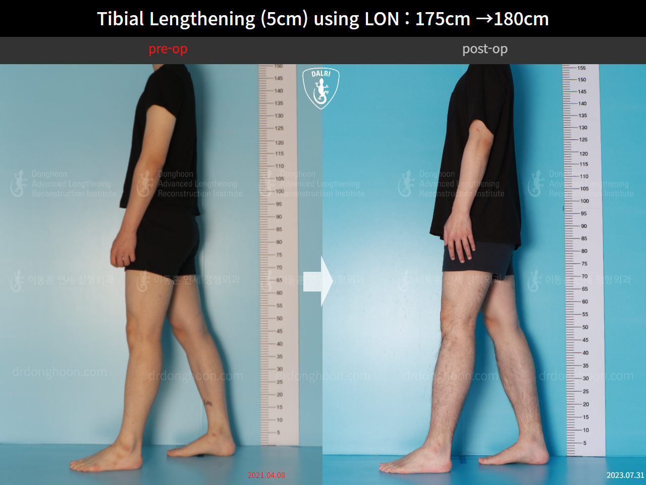 Before and after cll lon, case 15931051, image 4, Dr. Donghoon institute (DALRI)