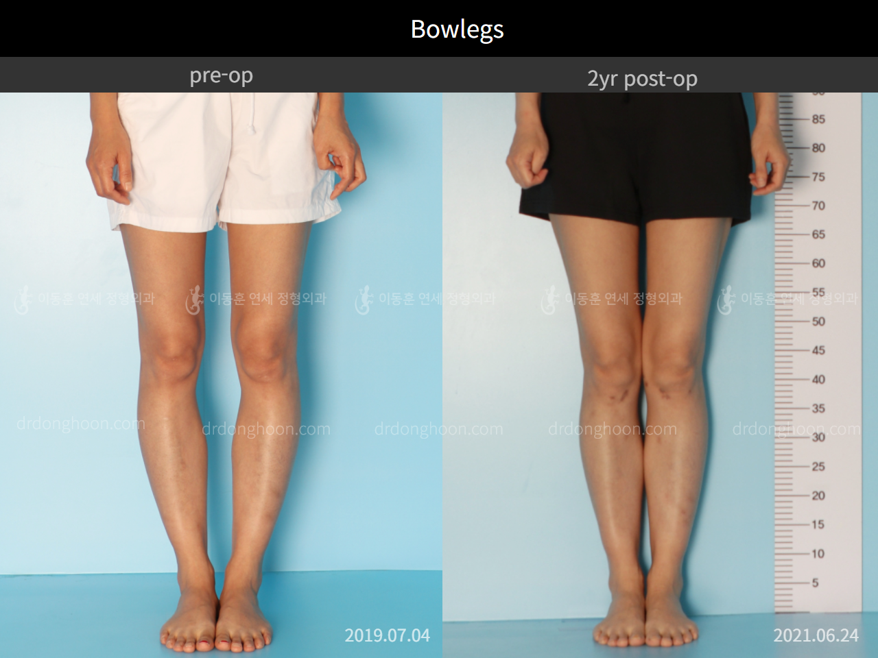Before and after adult bowlegs, case 7945709, image 1, Dr. Donghoon institute (DALRI)