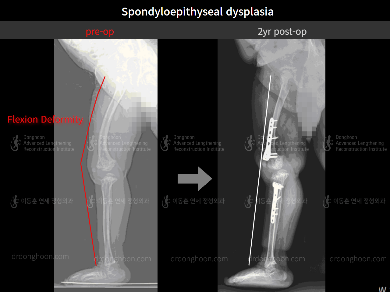 Before and after paediatric congenital condition, case 4304778, image 6, Dr. Donghoon institute (DALRI)