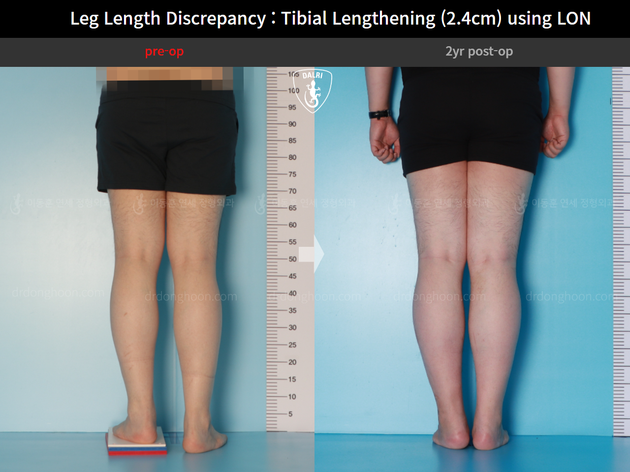 Before and after adult lld, case 15877698, image 6, Dr. Donghoon institute (DALRI)