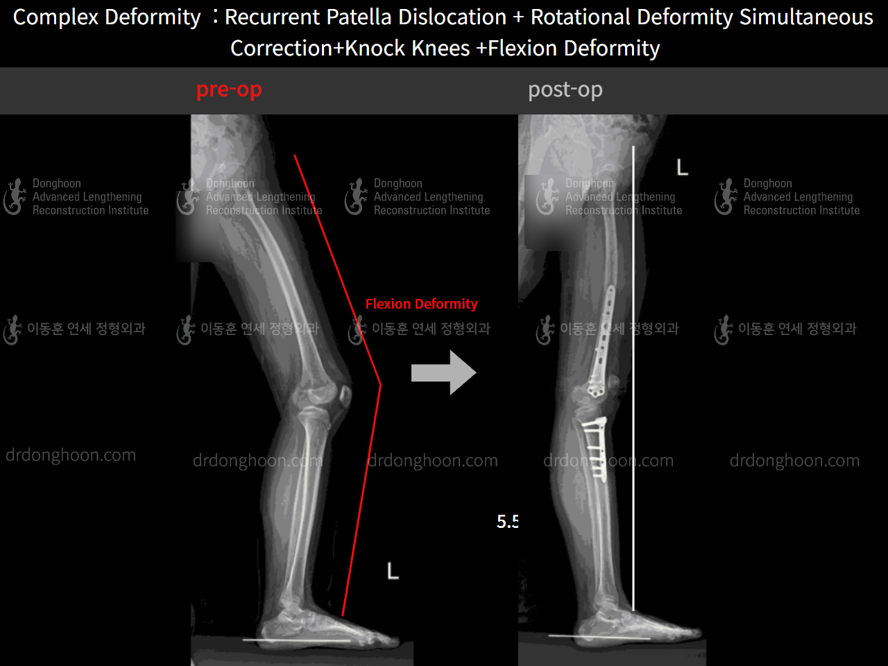Before and after recurrent patella dislocation, case 4263760, image 5, Dr. Donghoon institute (DALRI)