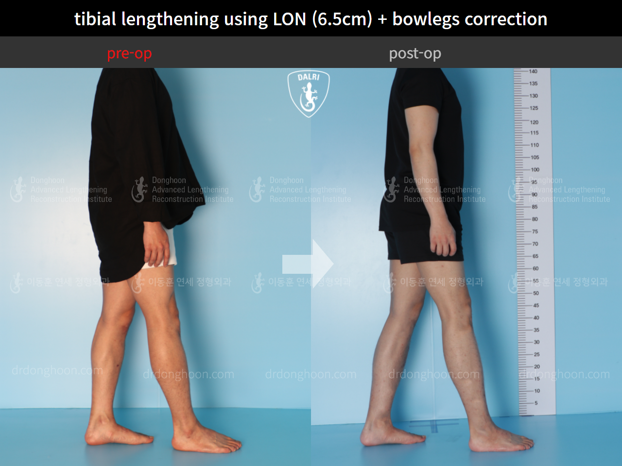 Before and after cll + deformity correction, case 4585639, image 4, Dr. Donghoon institute (DALRI)