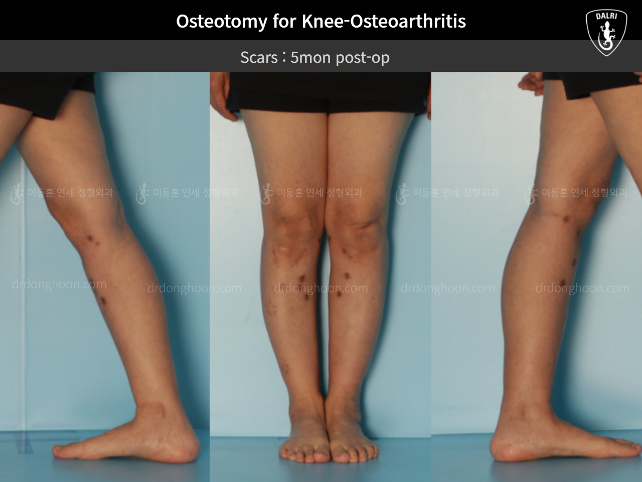 Before and after osteotomy for knee osteoarthritis, case 11047064, image 7, Dr. Donghoon institute (DALRI)