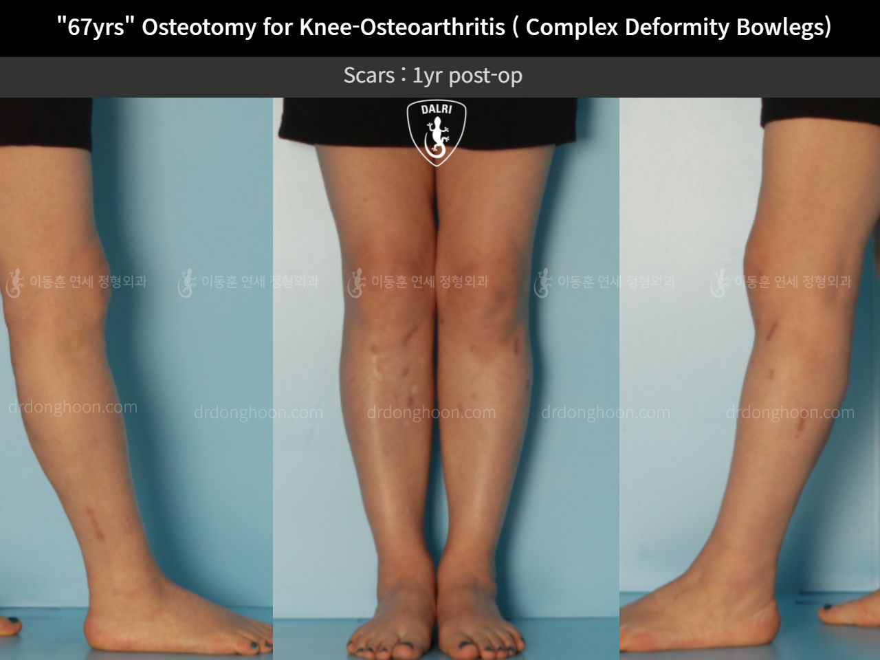 Before and after adult bowlegs, case 11339434, image 7, Dr. Donghoon institute (DALRI)