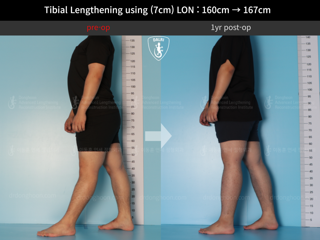 Before and after cll lon, case 12395704, image 4, Dr. Donghoon institute (DALRI)