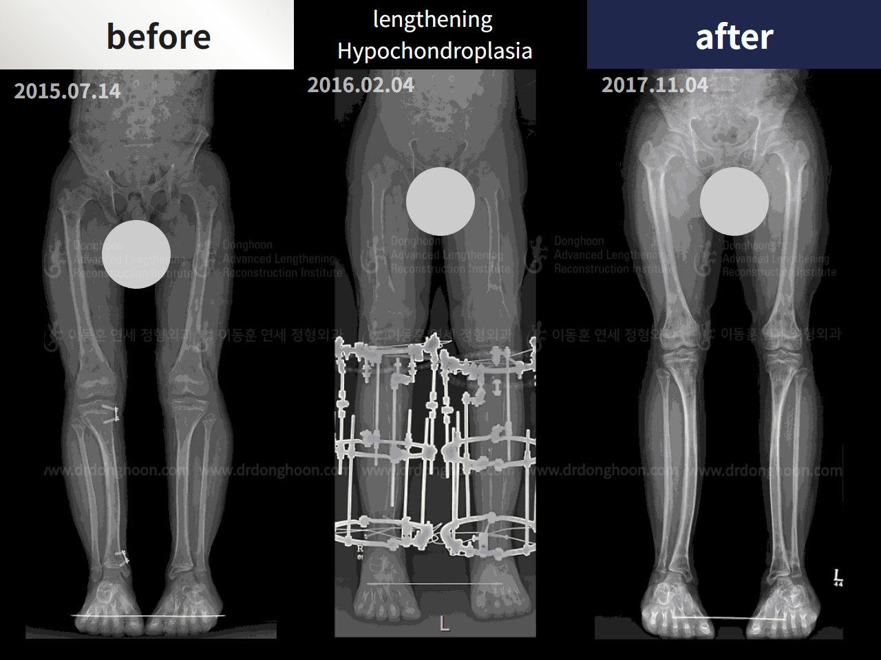 Before and after paediatric congenital condition, case 4304775, image 3, Dr. Donghoon institute (DALRI)