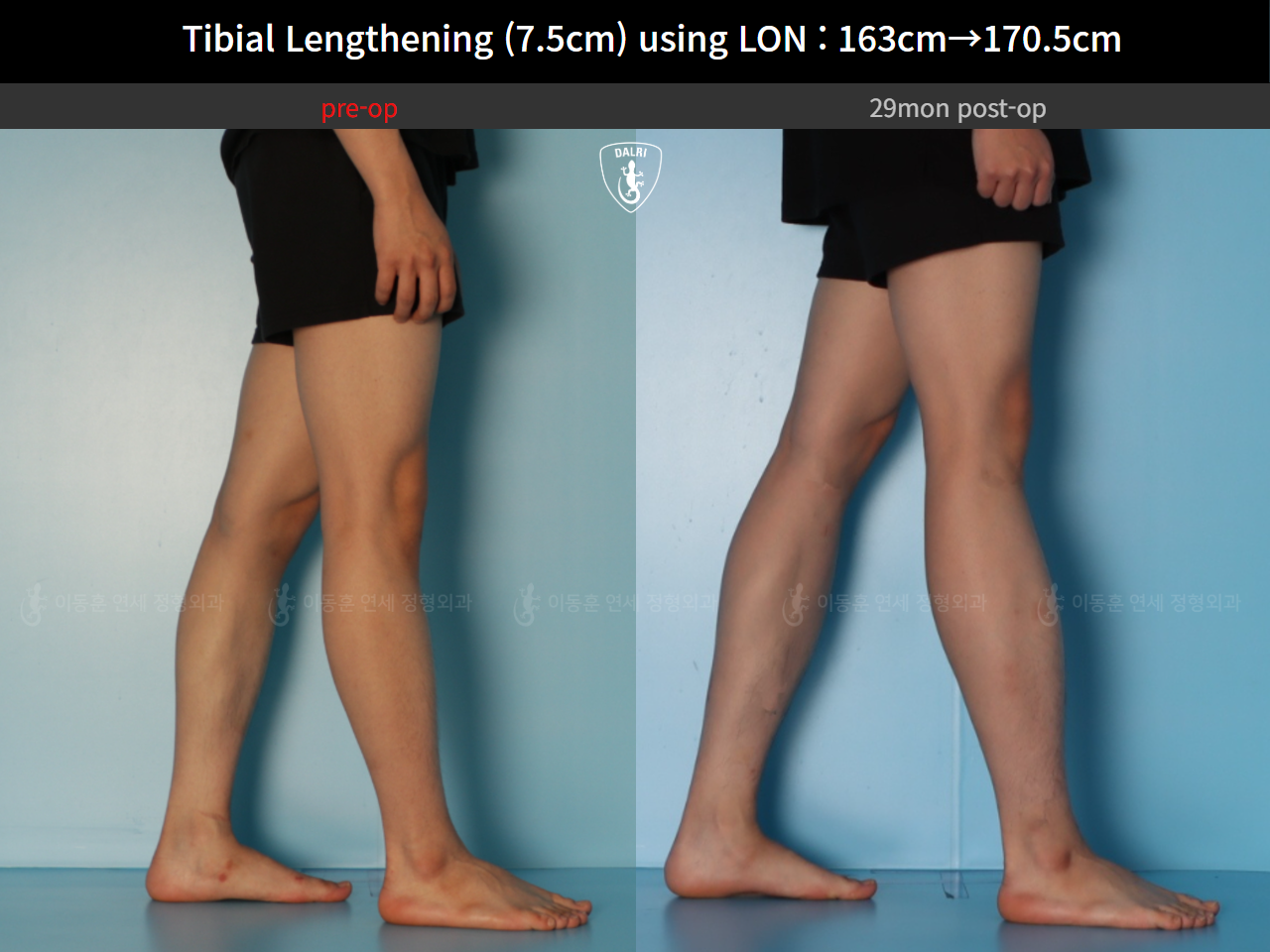 Before and after cll lon, case 127341676, image 9, Dr. Donghoon institute (DALRI)