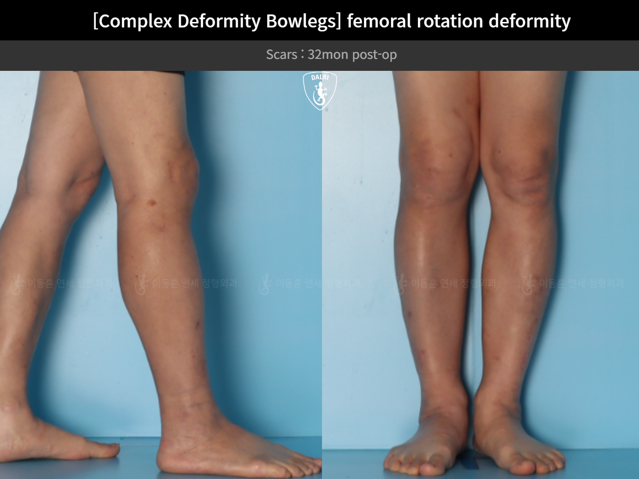 Before and after adult bowlegs, case 35242887, image 13, Dr. Donghoon institute (DALRI)