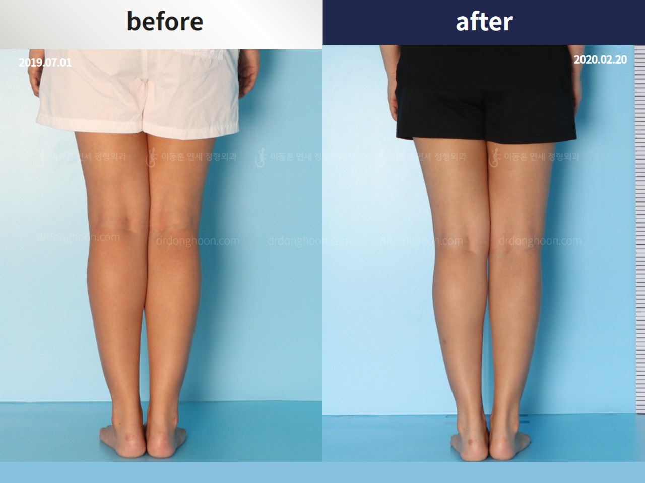 Before and after adult knock knees, case 4310881, image 4, Dr. Donghoon institute (DALRI)
