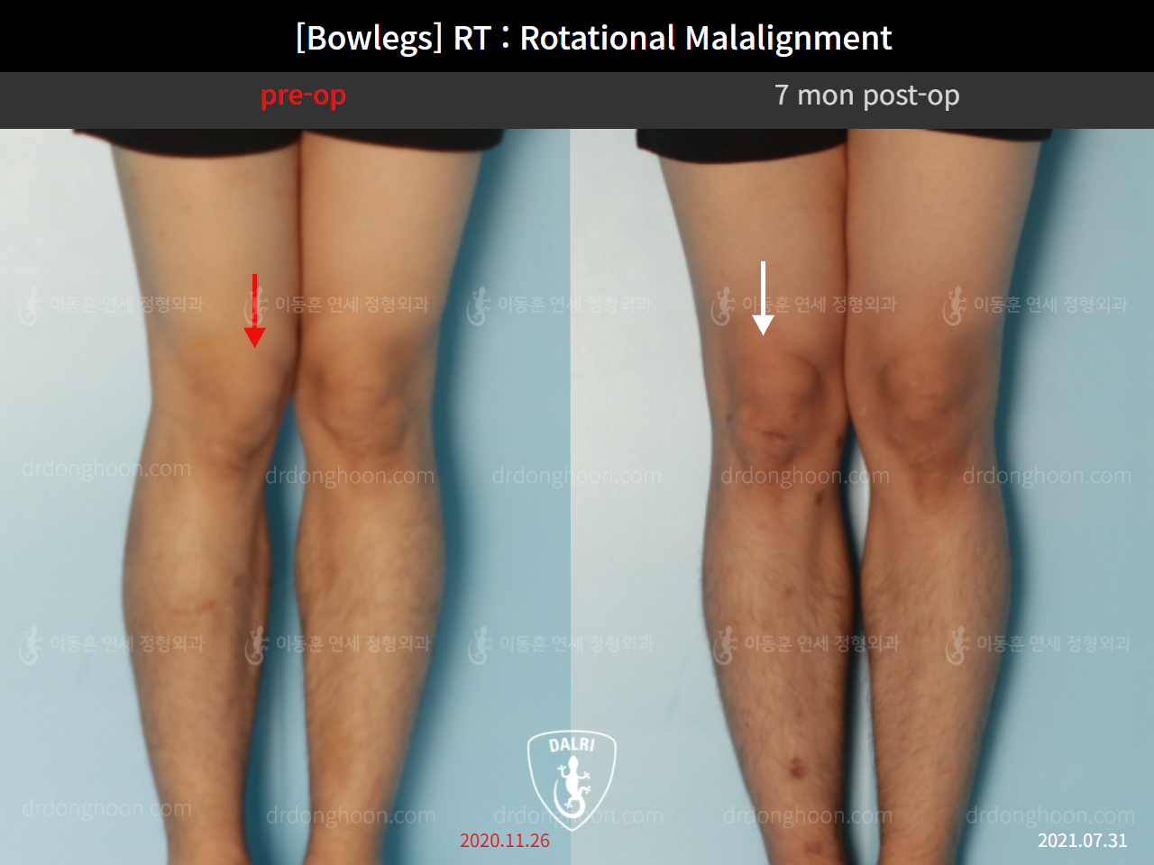 Before and after adult bowlegs, case 9190873, image 3, Dr. Donghoon institute (DALRI)