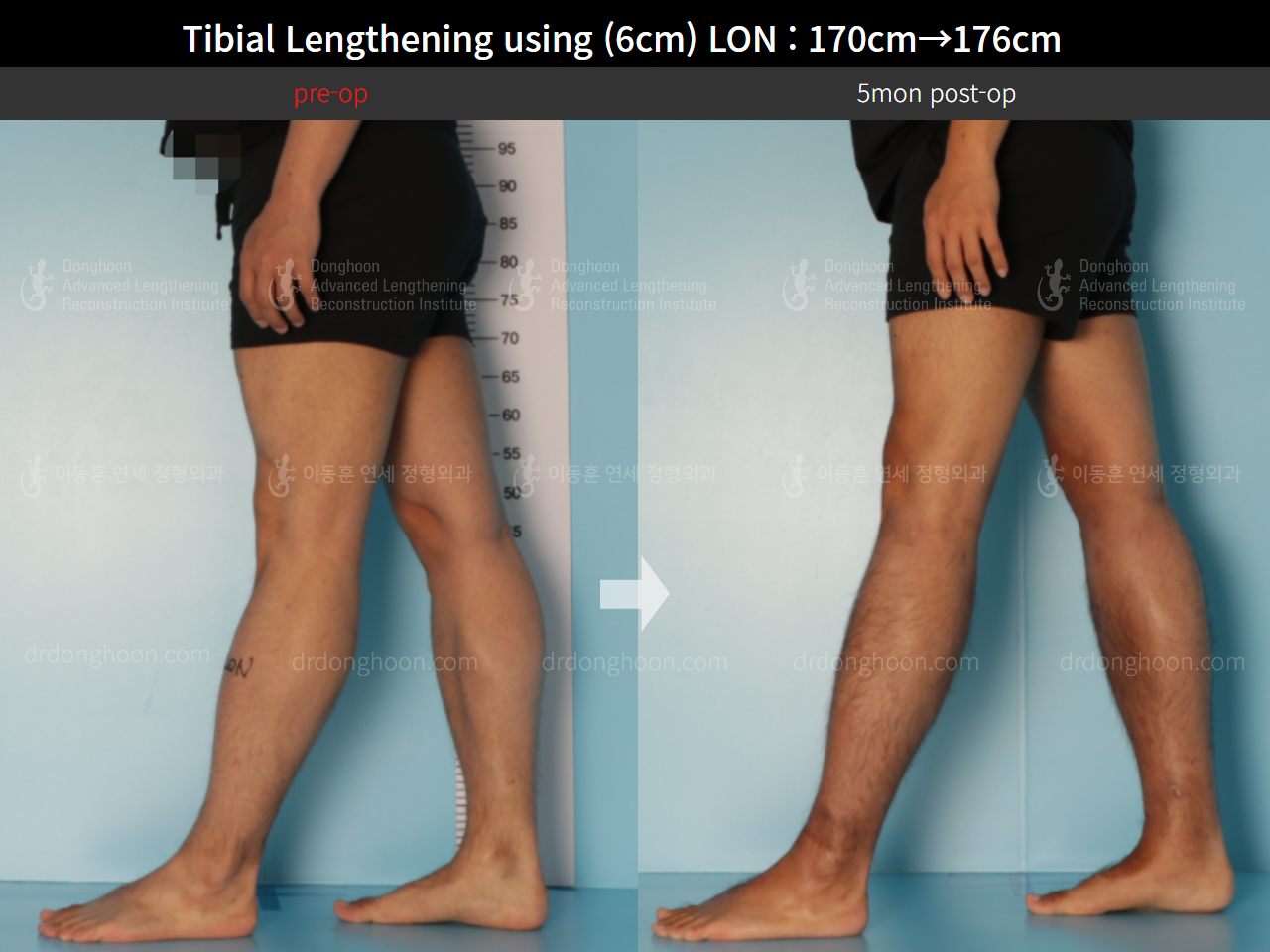 Before and after cll lon, case 8672248, image 7, Dr. Donghoon institute (DALRI)