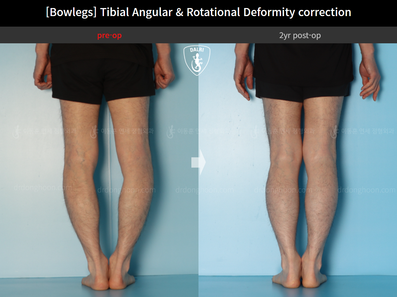 Before and after adult bowlegs, case 16933272, image 6, Dr. Donghoon institute (DALRI)