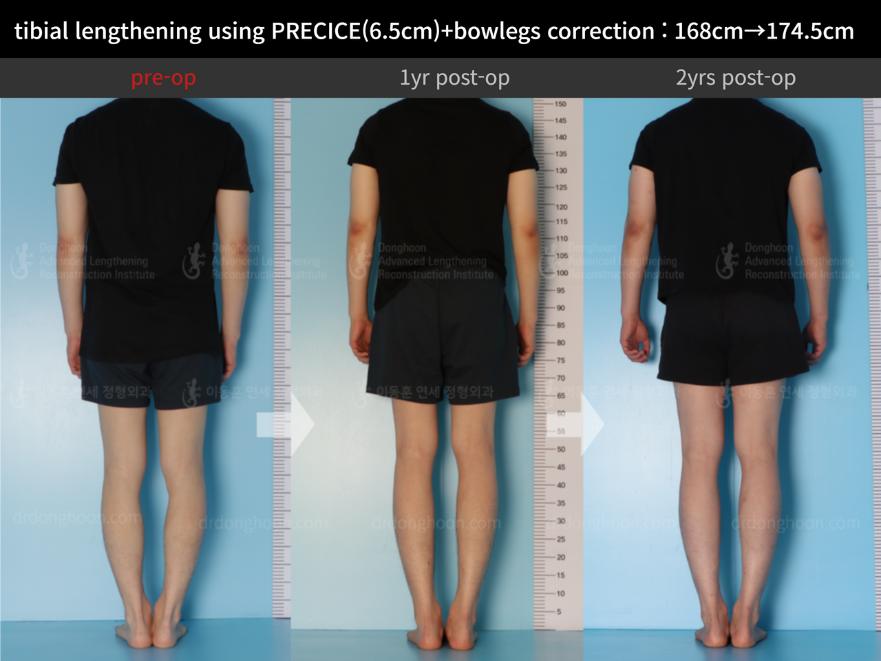 Before and after cll precice, case 12409993, image 3, Dr. Donghoon institute (DALRI)