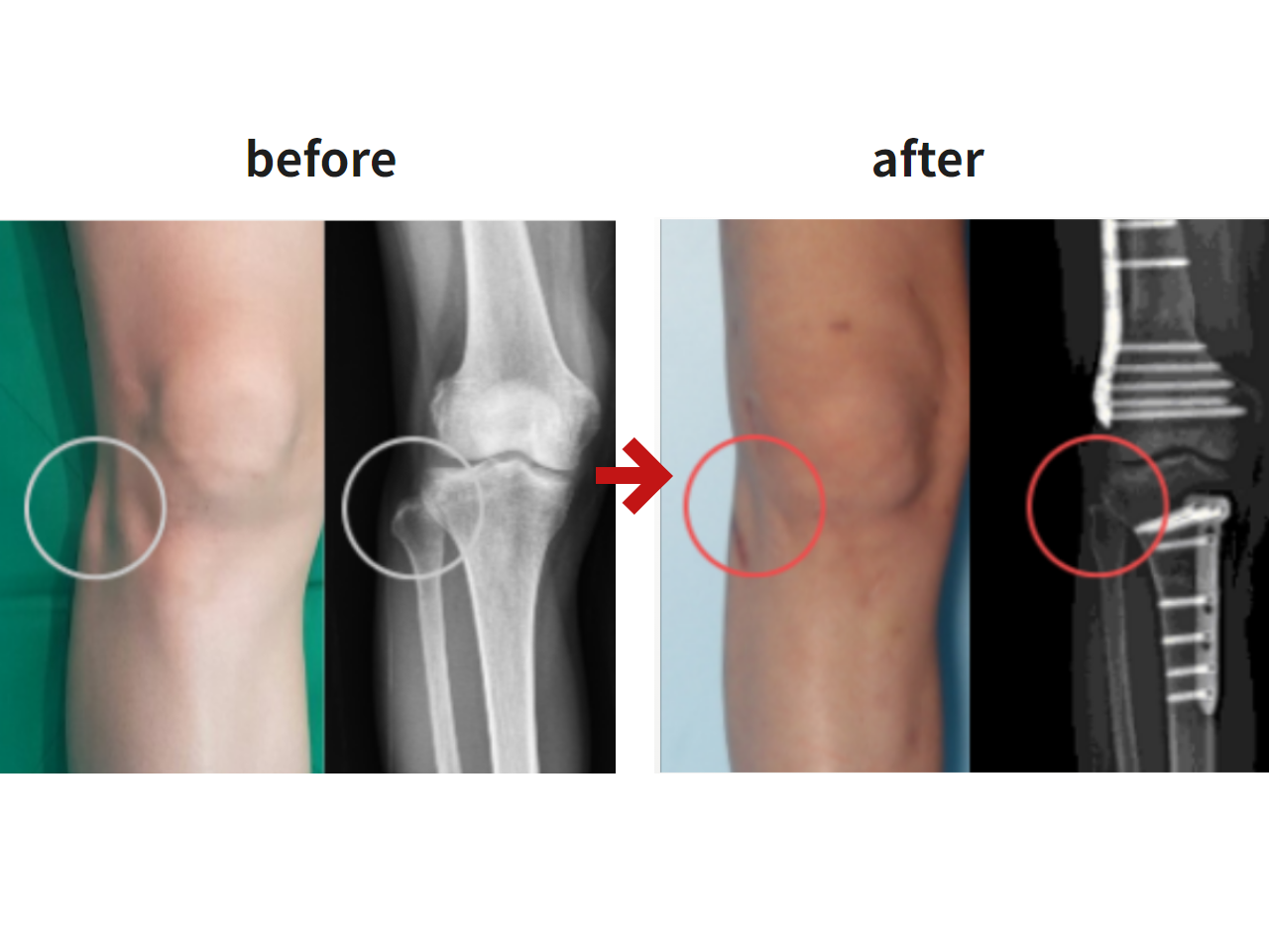 Before and after protruded fibular head, case 4578931, image 2, Dr. Donghoon institute (DALRI)