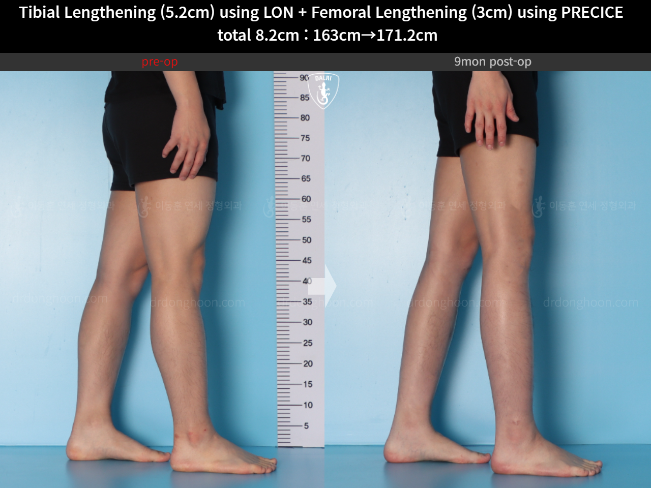 Before and after cll lon, case 15203339, image 12, Dr. Donghoon institute (DALRI)