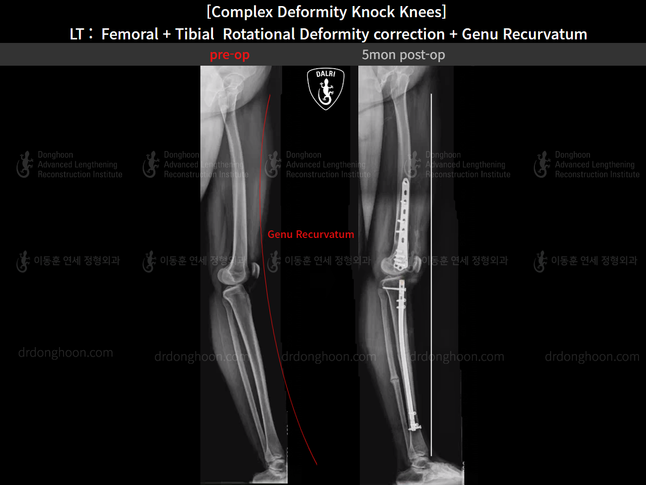 Before and after genu recurvatum, case 16212778, image 15, Dr. Donghoon institute (DALRI)