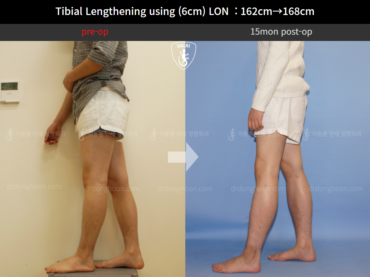 Before and after cll lon, case 4323473, image 3, Dr. Donghoon institute (DALRI)