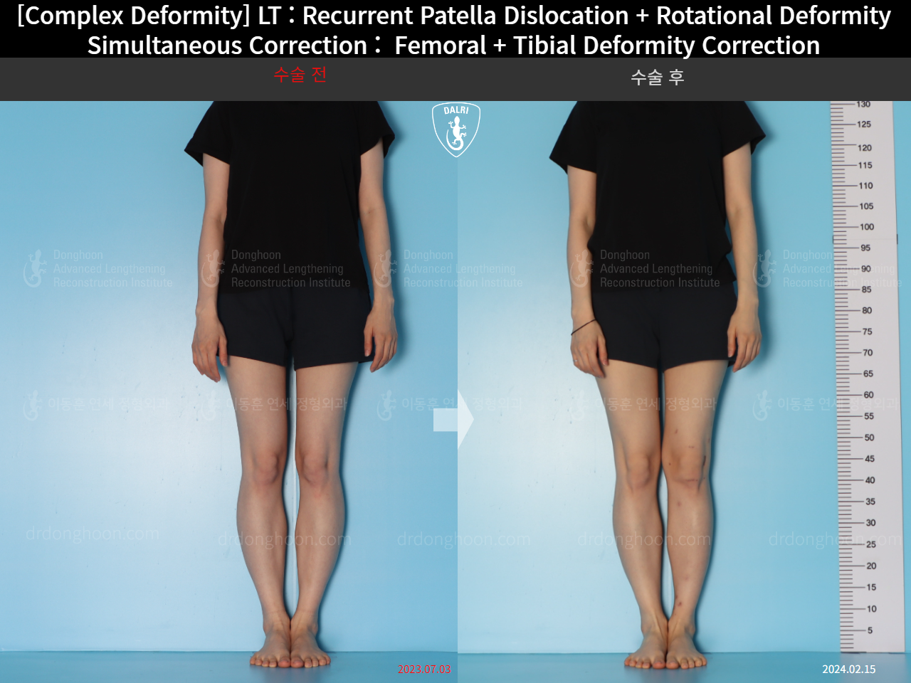 Before and after recurrent patella dislocation, case 18088207, image 5, Dr. Donghoon institute (DALRI)