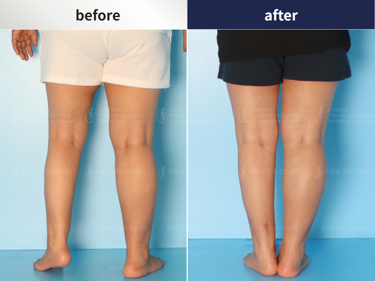 Before and after complex deformity, case 4251607, image 2, Dr. Donghoon institute (DALRI)