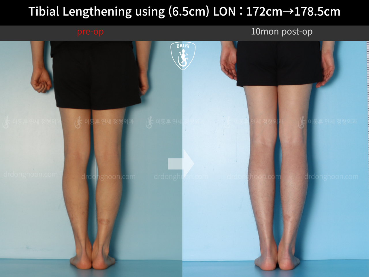 Before and after cll lon, case 13642628, image 5, Dr. Donghoon institute (DALRI)