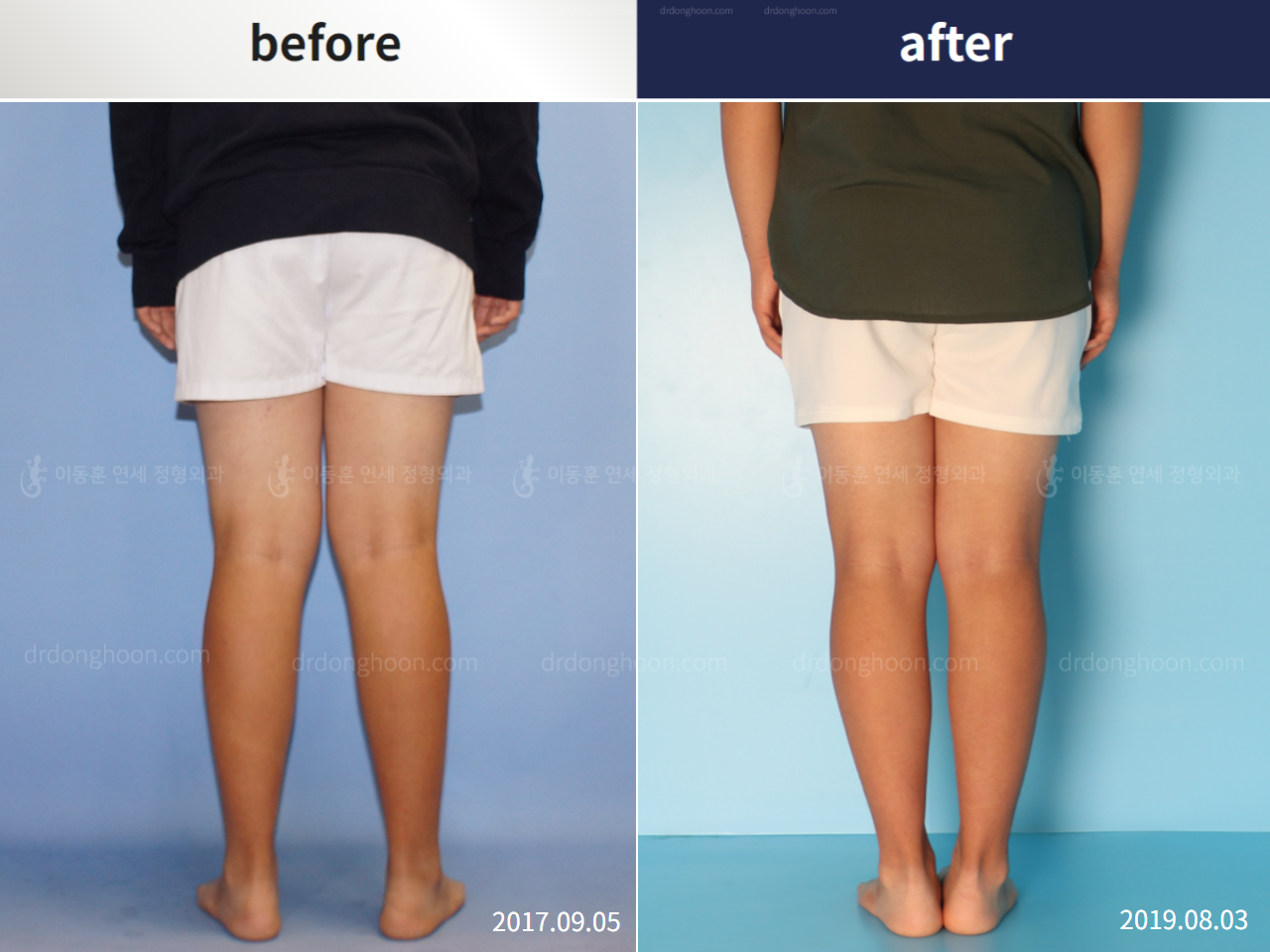 Before and after paediatric & adolescent knock knees, case 5372572, image 2, Dr. Donghoon institute (DALRI)