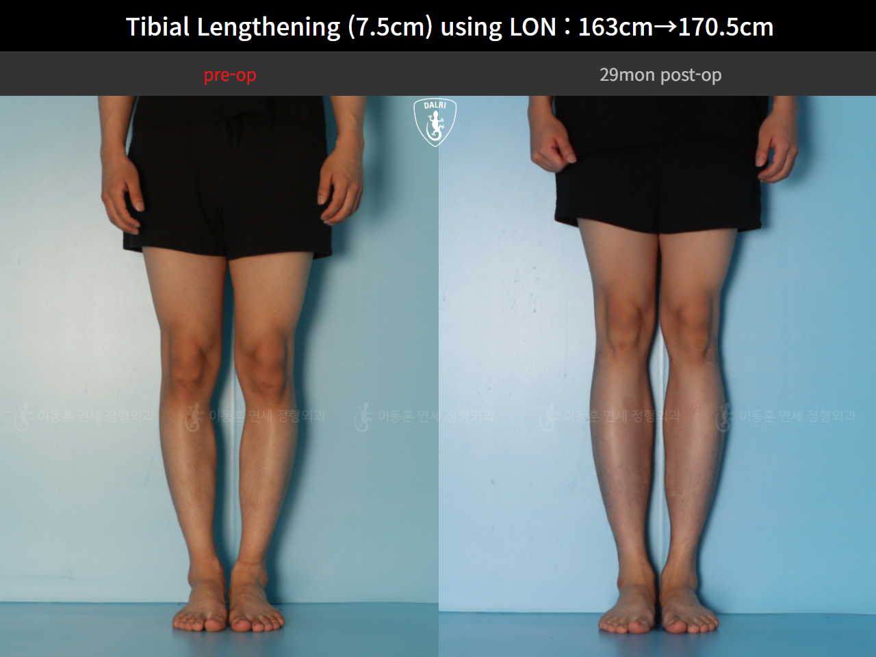 Before and after cll lon, case 127341676, image 7, Dr. Donghoon institute (DALRI)