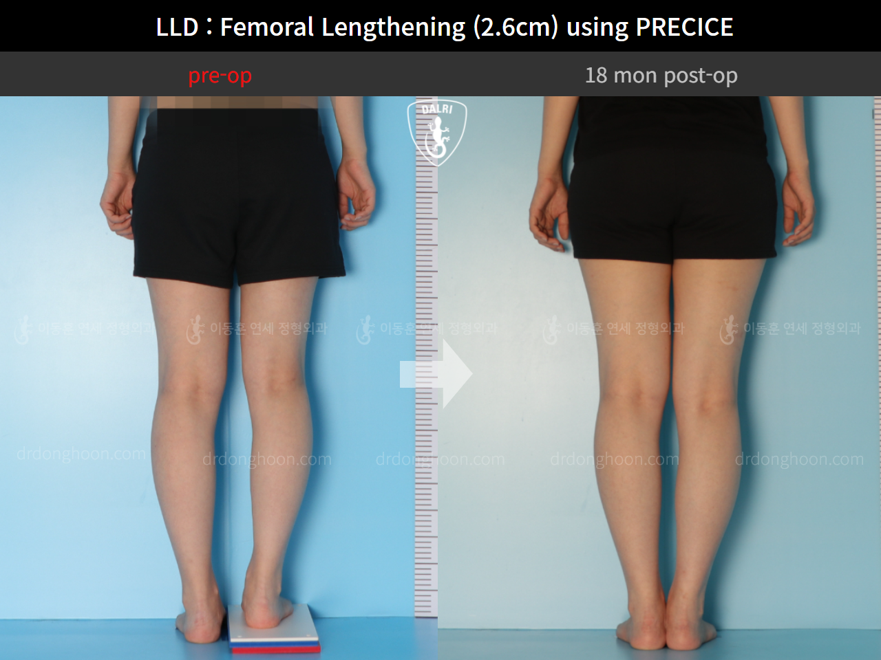 Before and after adult lld, case 9332755, image 5, Dr. Donghoon institute (DALRI)
