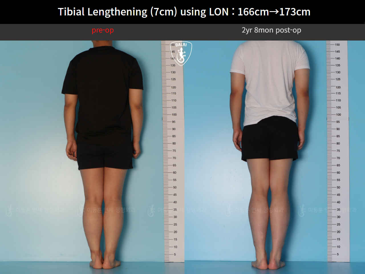Before and after cll lon, case 127679780, image 2, Dr. Donghoon institute (DALRI)