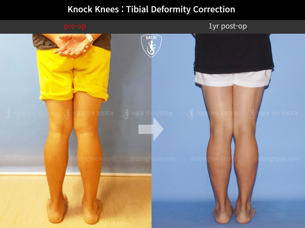 Before and after adult knock knees, case 11468369, image 4, Dr. Donghoon institute (DALRI)