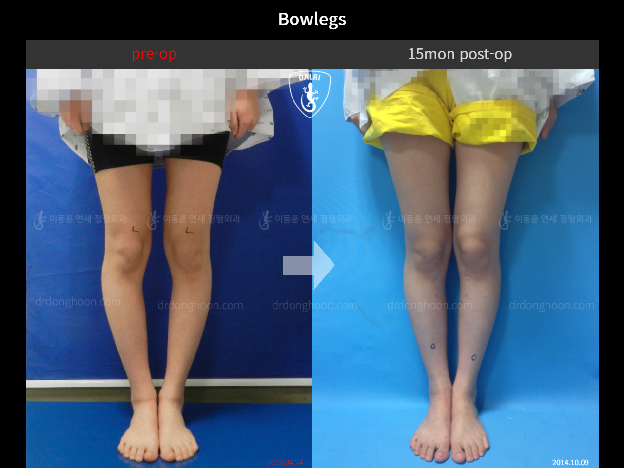 Before and after adult bowlegs, case 4310970, image 3, Dr. Donghoon institute (DALRI)