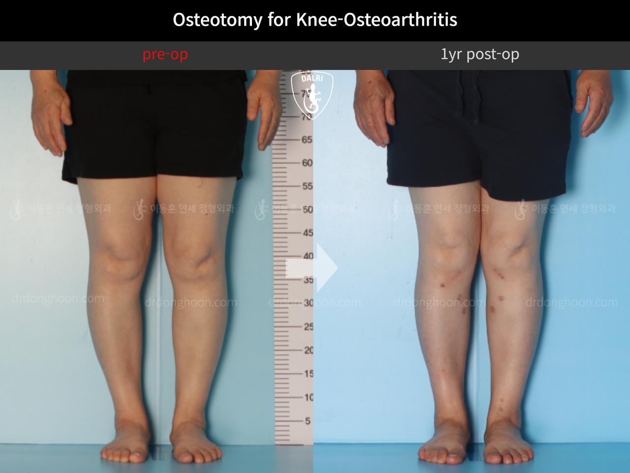 Before and after osteotomy for knee osteoarthritis, case 13231794, image 3, Dr. Donghoon institute (DALRI)