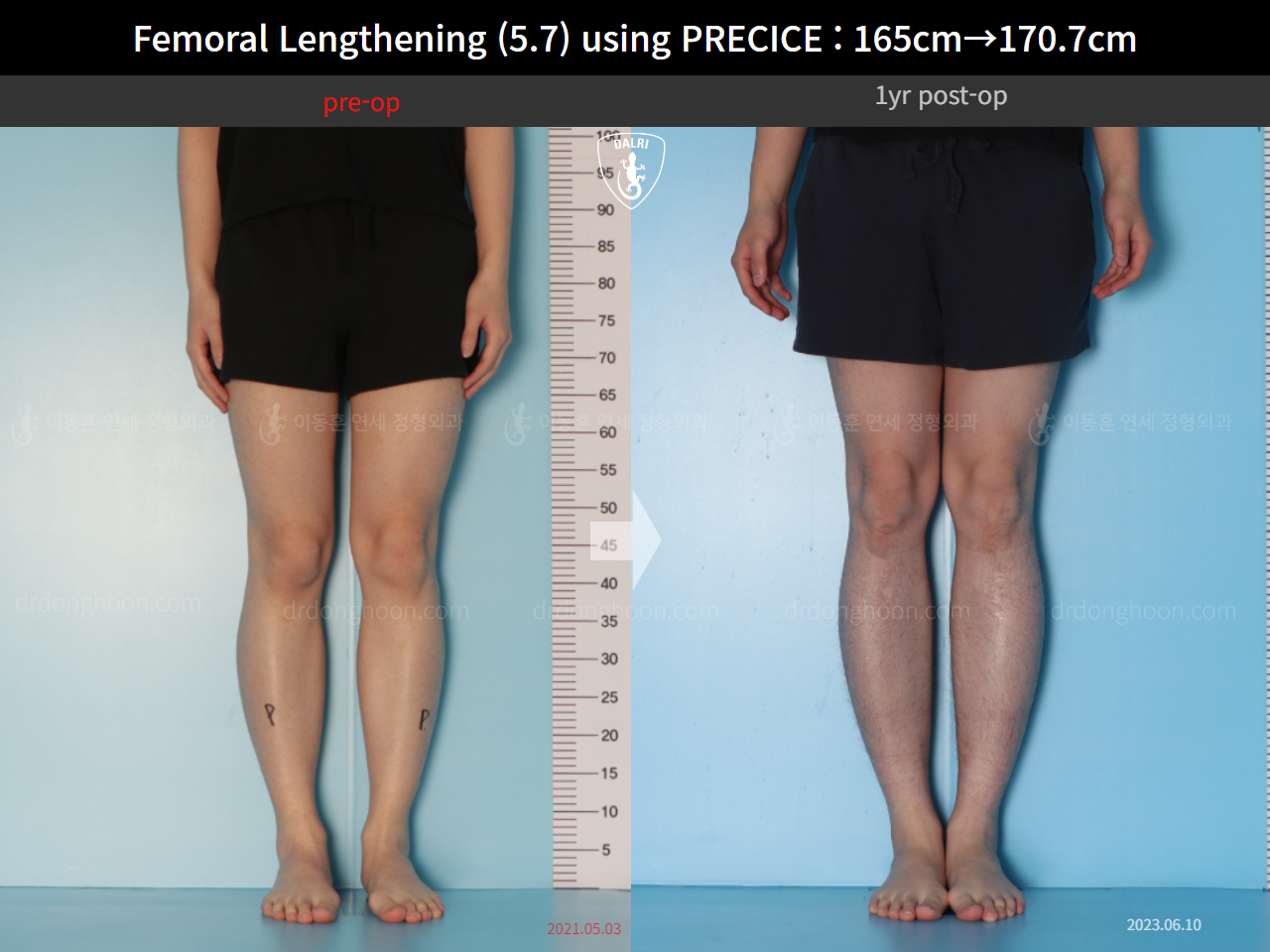 Before and after cll precice, case 15417090, image 7, Dr. Donghoon institute (DALRI)