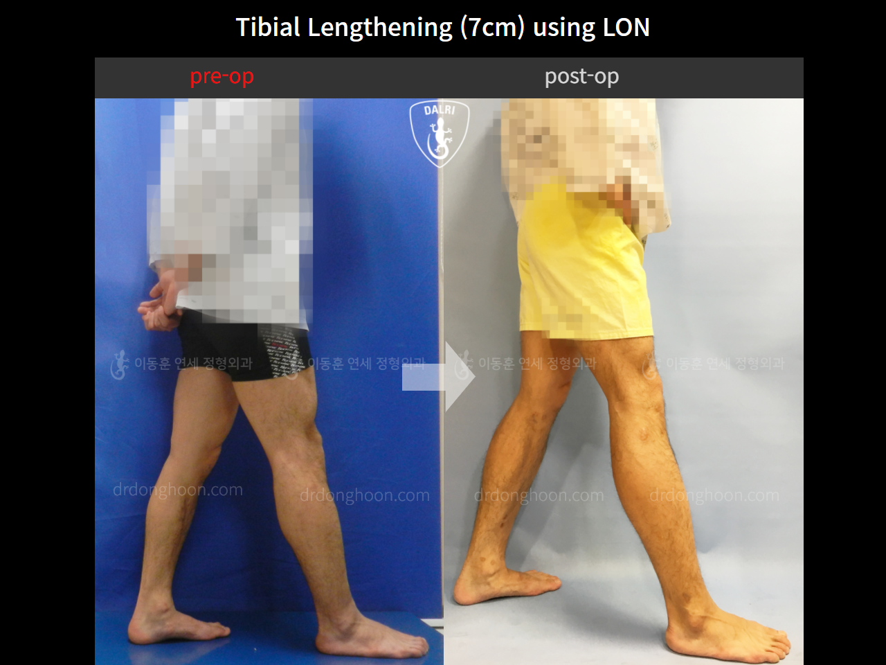 Before and after cll lon, case 9992836, image 3, Dr. Donghoon institute (DALRI)