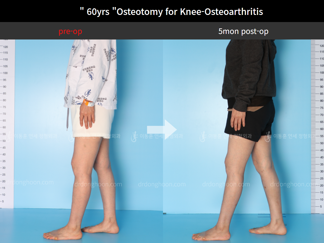 Before and after osteotomy for knee osteoarthritis, case 4586357, image 3, Dr. Donghoon institute (DALRI)