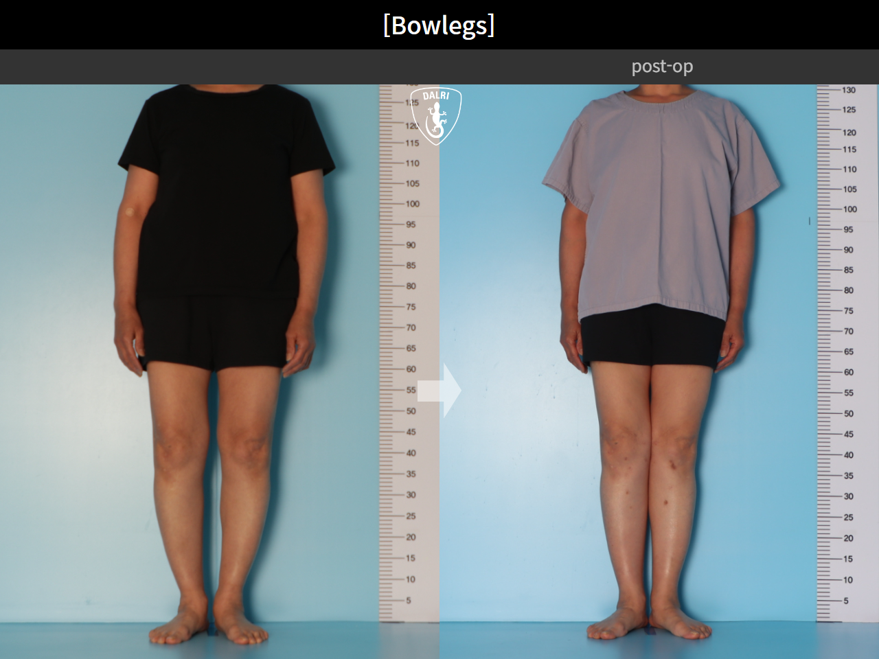 Before and after adult bowlegs, case 30770070, image 3, Dr. Donghoon institute (DALRI)