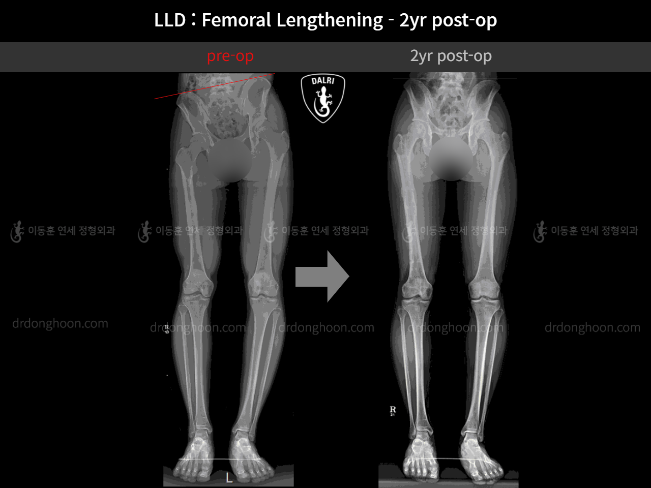 Before and after adult lld, case 4320322, image 5, Dr. Donghoon institute (DALRI)