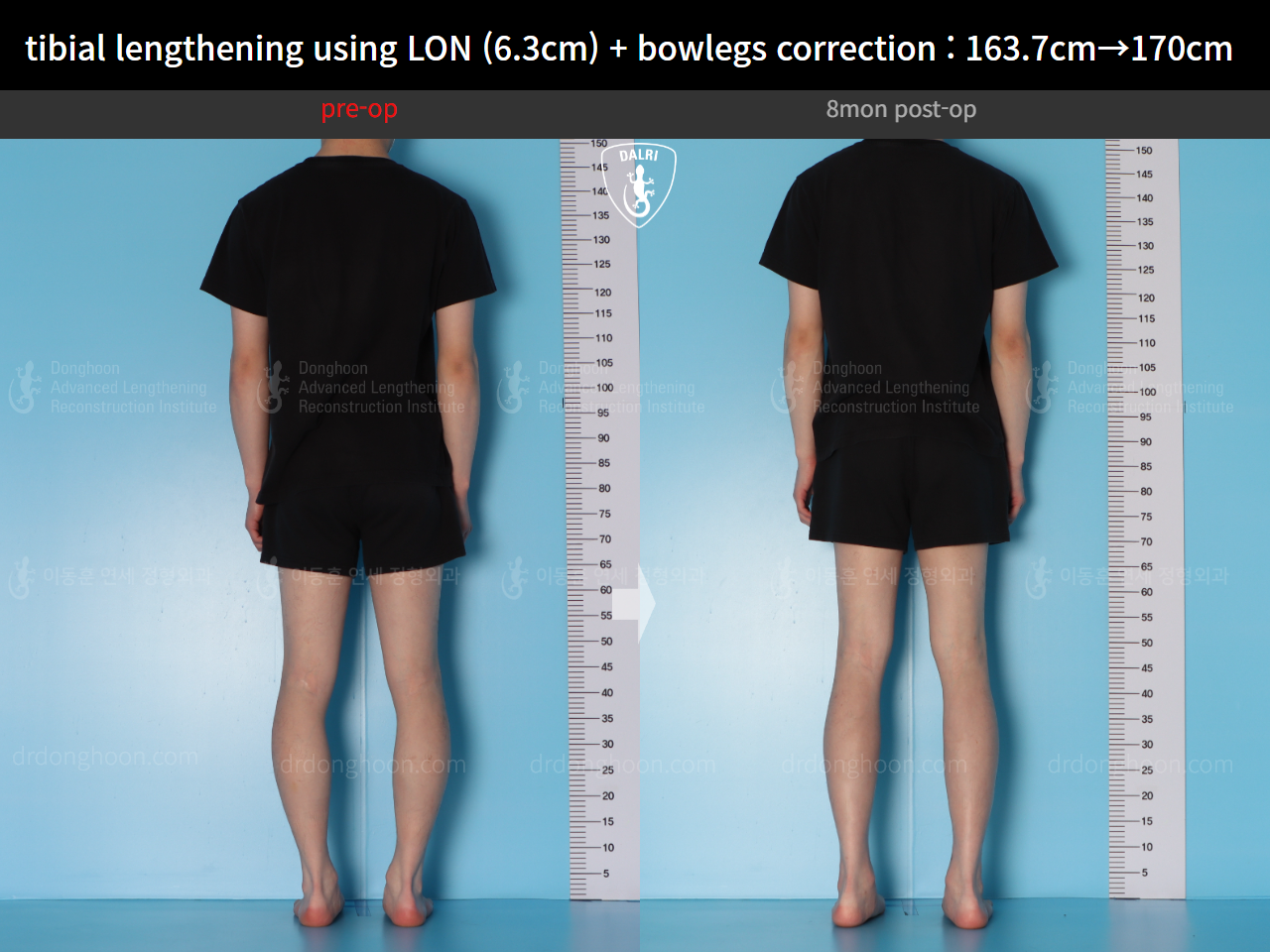 Before and after cll + deformity correction, case 16853829, image 3, Dr. Donghoon institute (DALRI)