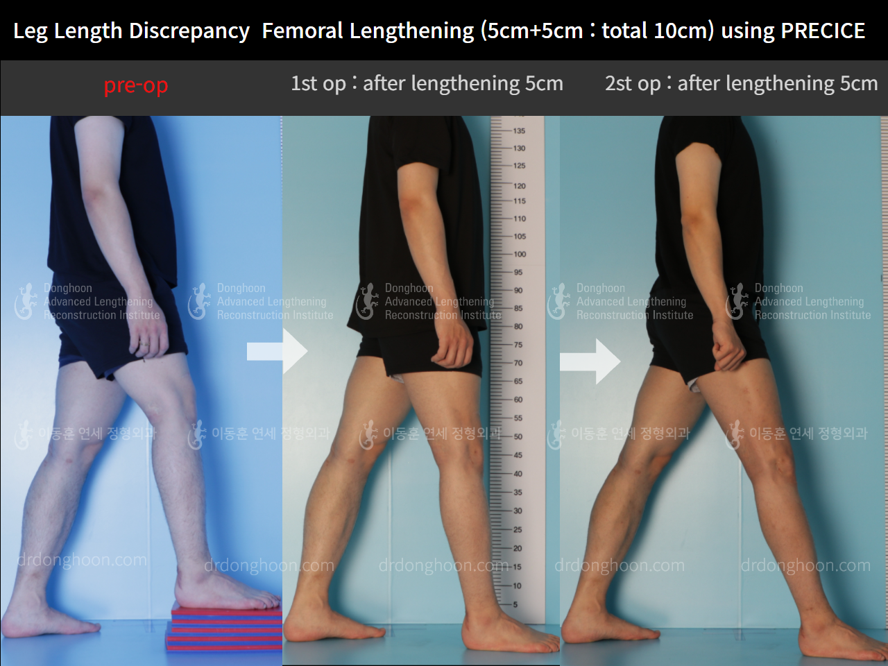 Before and after adult lld, case 9100401, image 3, Dr. Donghoon institute (DALRI)
