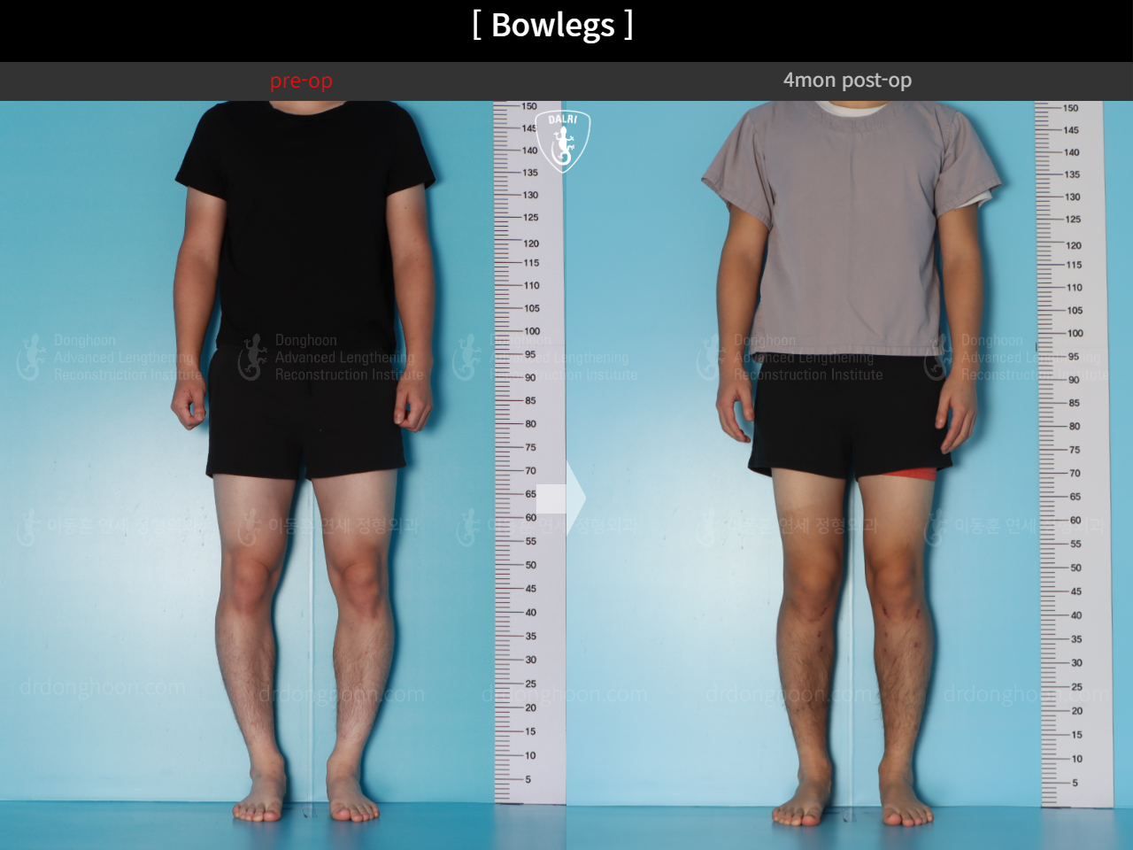 Before and after adult bowlegs, case 18479637, image 3, Dr. Donghoon institute (DALRI)