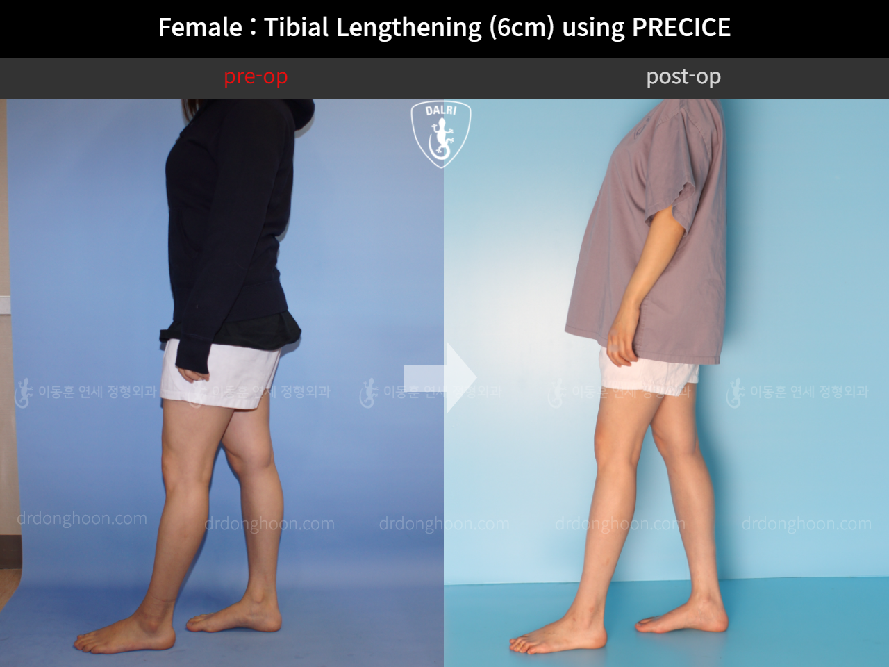 Before and after cll precice, case 11653827, image 3, Dr. Donghoon institute (DALRI)