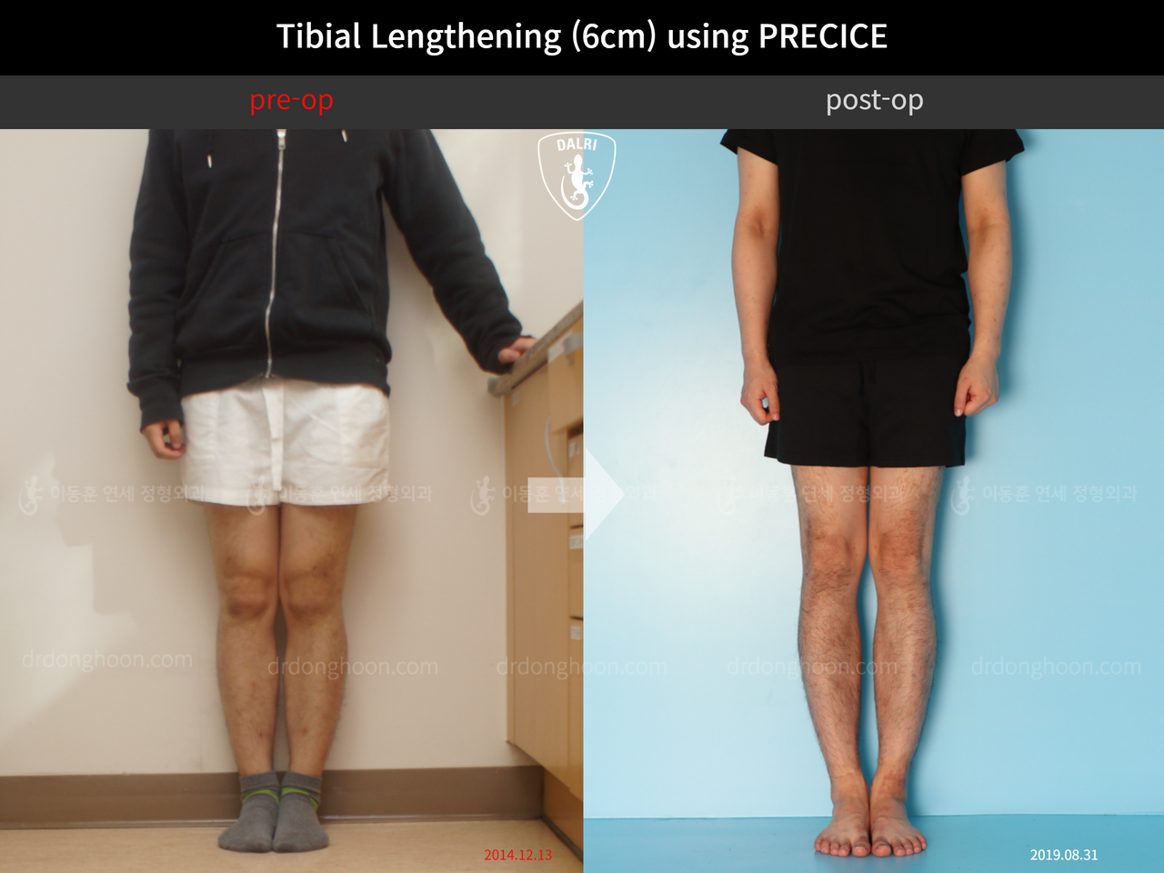 Before and after cll precice, case 11882006, image 1, Dr. Donghoon institute (DALRI)