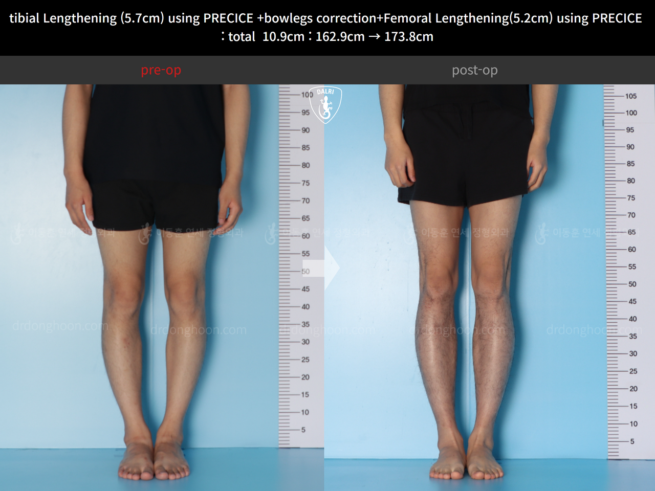 Before and after cll precice, case 13924906, image 5, Dr. Donghoon institute (DALRI)